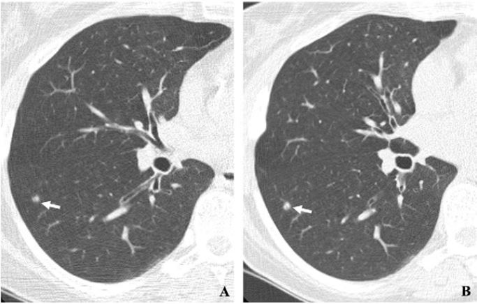 20-year study shows that lung cancer screening boosts survival rates